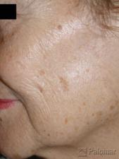 Laserowe Usuwanie Przebarwień