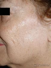 Laserowe Usuwanie Przebarwień