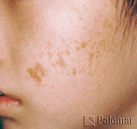 Laserowe Usuwanie Przebarwień