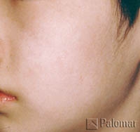 Laserowe Usuwanie Przebarwień