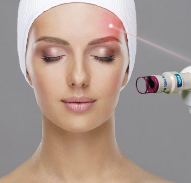 Laser frakcyjny CO2 - Odmładzanie, usuwanie zmarszczek i lifting skóry