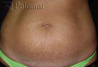 Laserowe Usuwanie Rozstępów