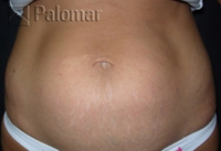 Laserowe Usuwanie Rozstępów