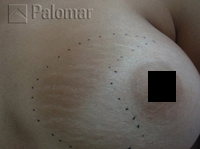 Laserowe Usuwanie Rozstępów