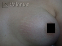 Laserowe Usuwanie Rozstępów