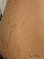 Laserowe Usuwanie Rozstępów