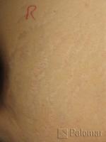 Laserowe Usuwanie Rozstępów