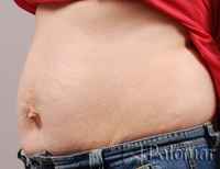 Laserowe Usuwanie Rozstępów