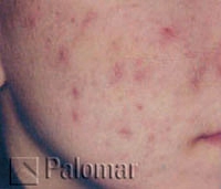 Laserowe Leczenie Trądziku