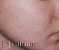 Laserowe Leczenie Trądziku