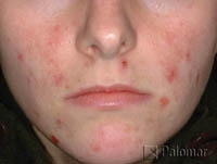 Laserowe Leczenie Trądziku