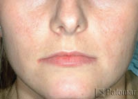 Laserowe Leczenie Trądziku