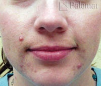 Laserowe Leczenie Trądziku