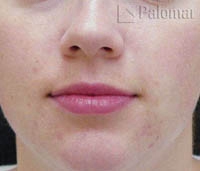 Laserowe Leczenie Trądziku