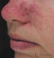 Laserowe Leczenie Trądziku