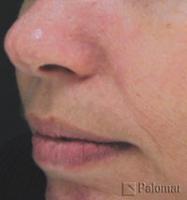 Laserowe Leczenie Trądziku